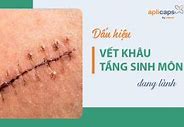 Hình Ảnh Vết Khâu Tầng Sinh Môn Bị Lồi